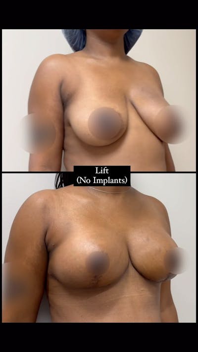 Reels Gallery Before & After Gallery - Patient 285961 - Image 1