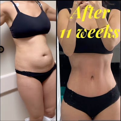 Reels Gallery Before & After Gallery - Patient 191044 - Image 1