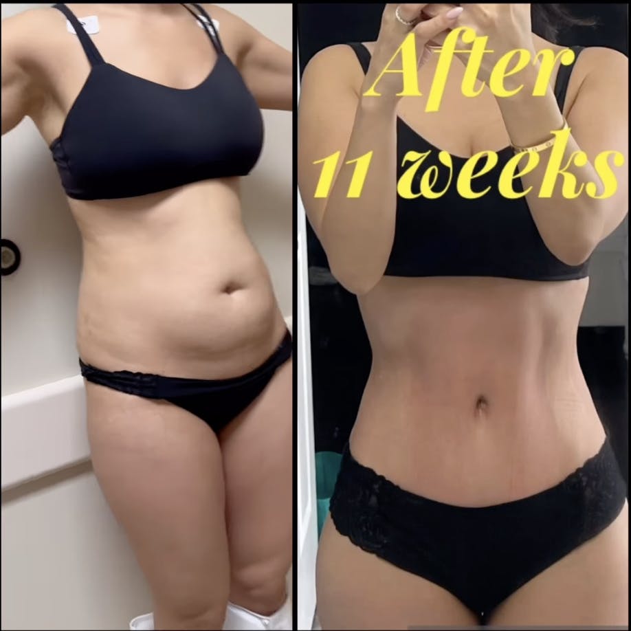 Reels Gallery - Archive of instagram images etc Before & After Gallery - Patient 191044 - Image 1