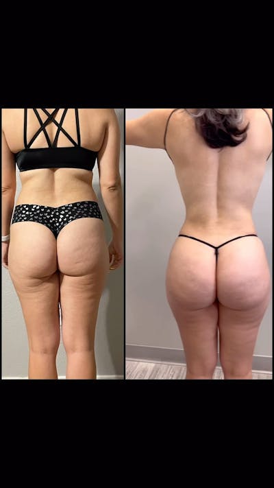 Reels Gallery Before & After Gallery - Patient 287723 - Image 1