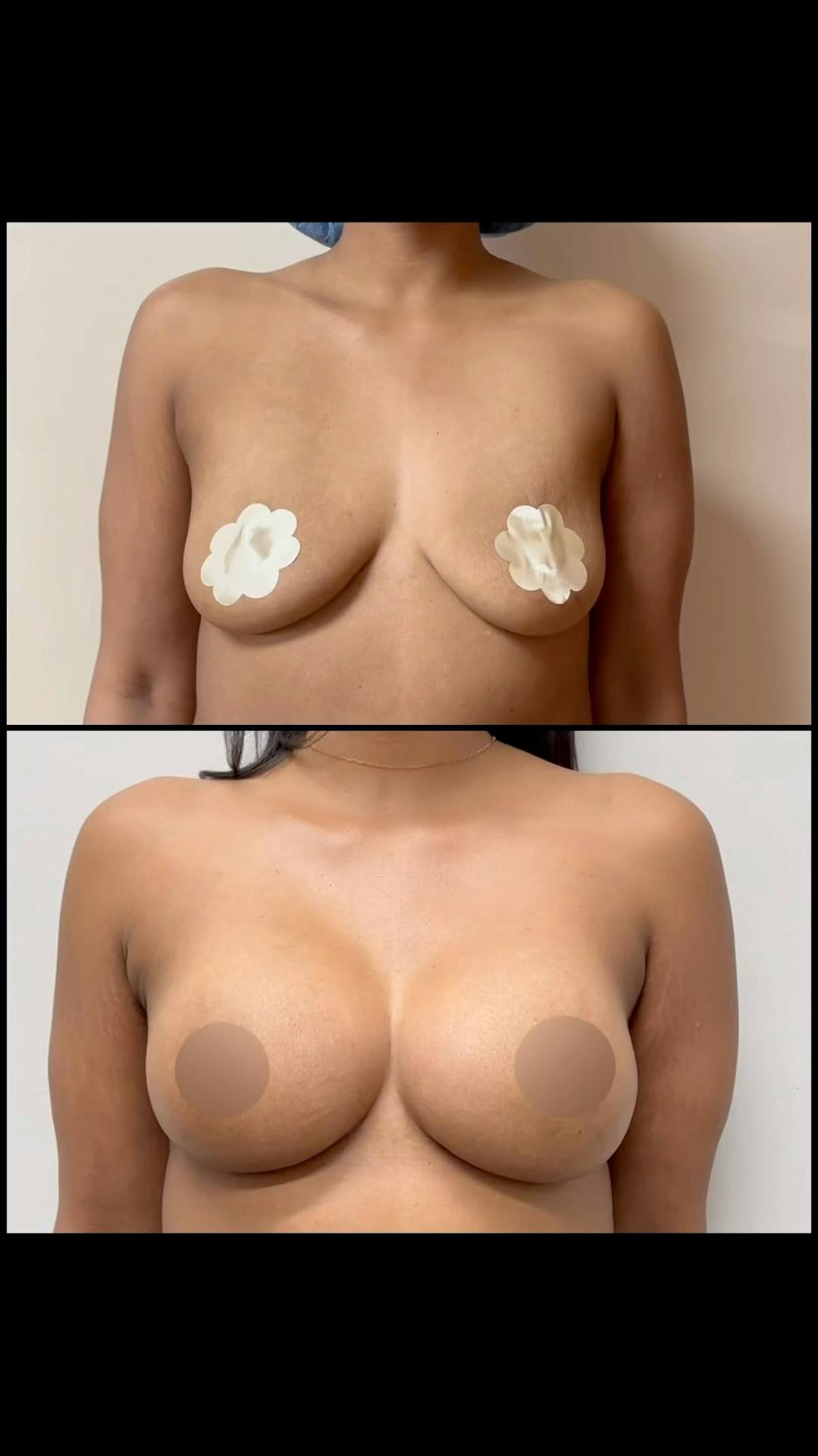 Reels Gallery Before & After Gallery - Patient 399821 - Image 1