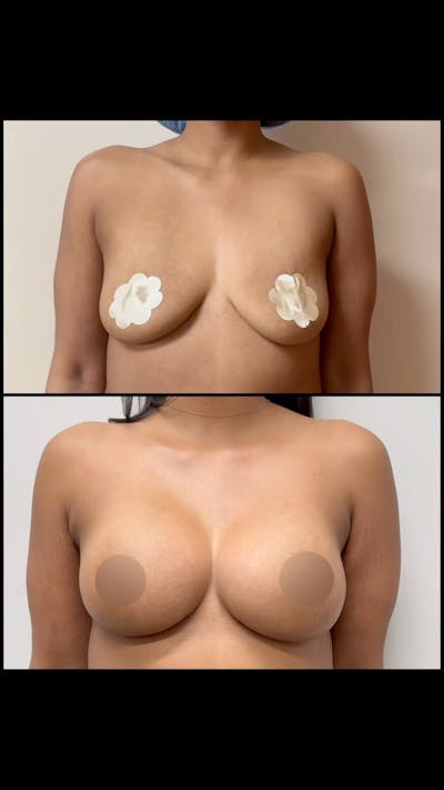 Reels Gallery Before & After Gallery - Patient 399821 - Image 1