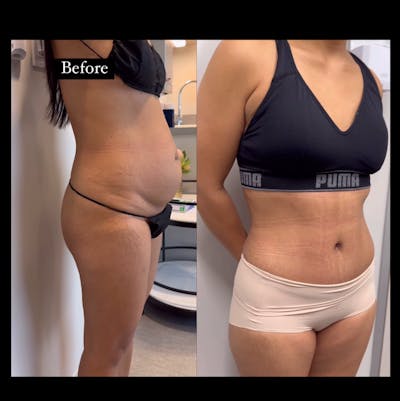 Reels Gallery Before & After Gallery - Patient 281090 - Image 1