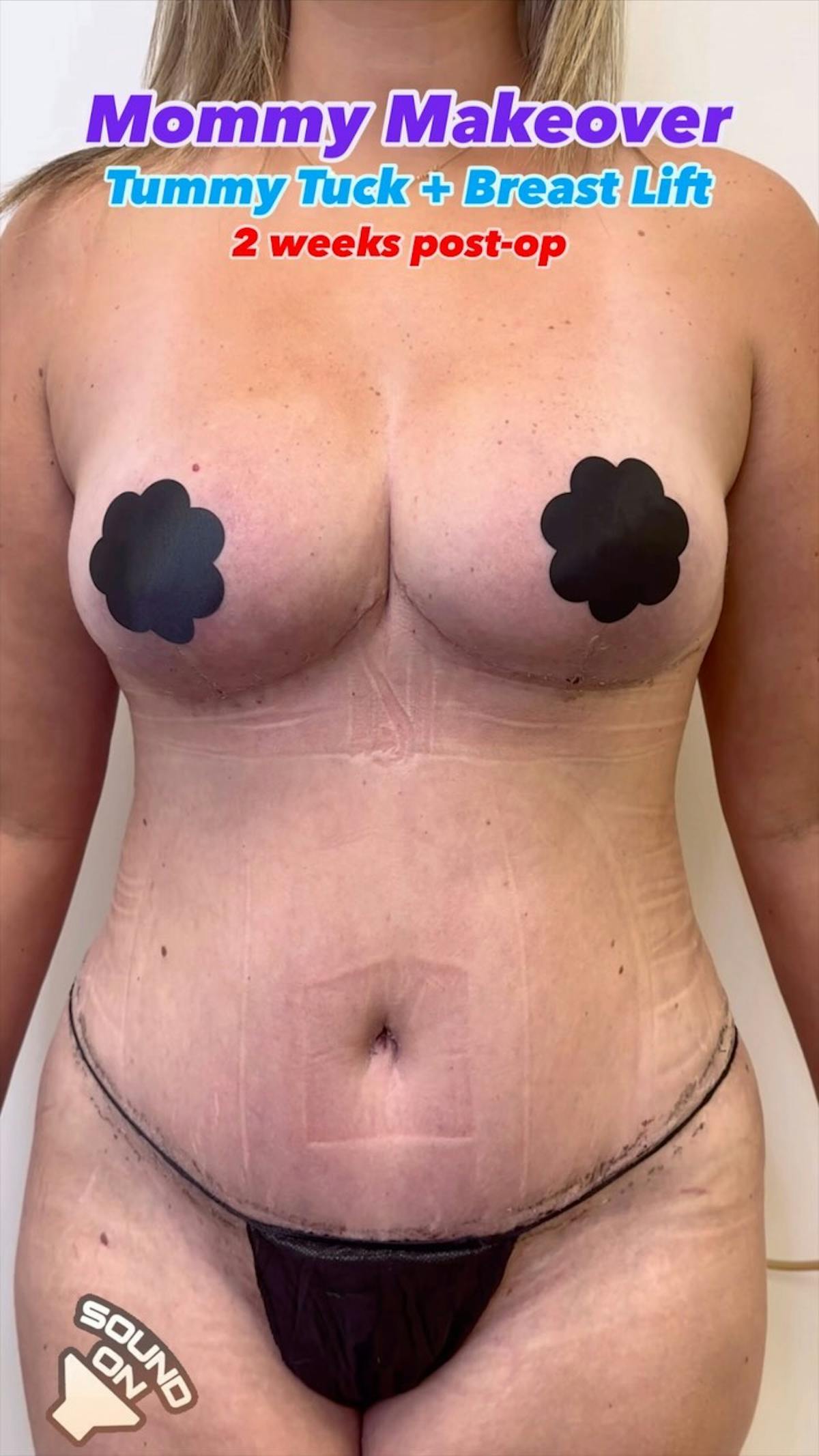 Reels Gallery Before & After Gallery - Patient 416582 - Image 1