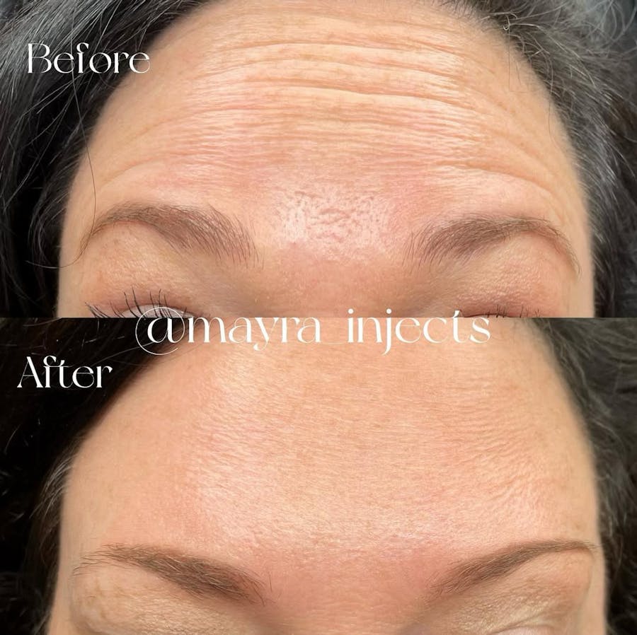 Botox/Dysport Before & After - Image 2