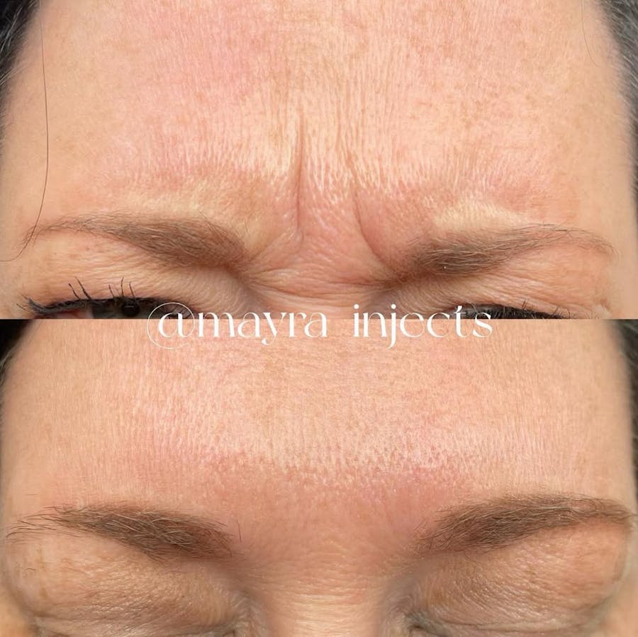 Botox/Dysport Before & After - image 1