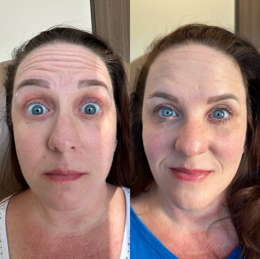 Botox/Dysport Before & After - Image 3