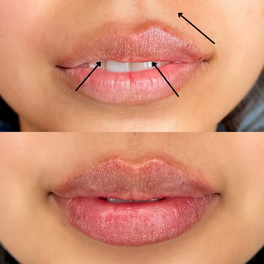 Lip Filler Before and After - Image 2