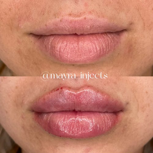 Lip Filler B&A - image 1