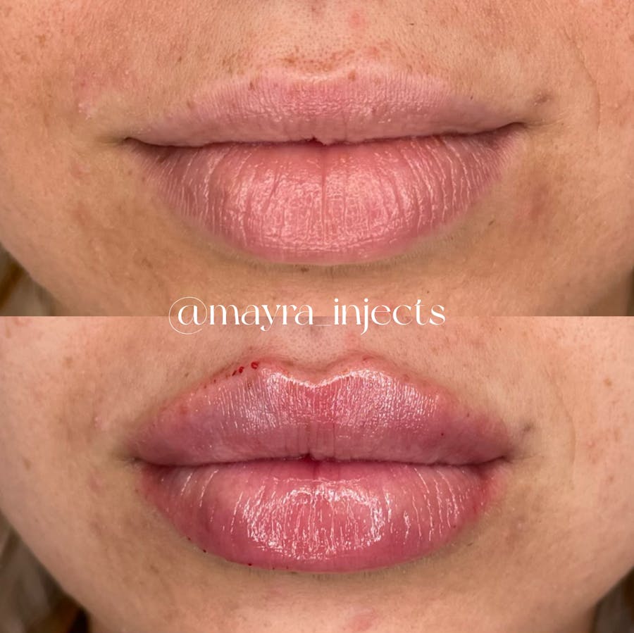 Lip Filler Before and After - Image 1