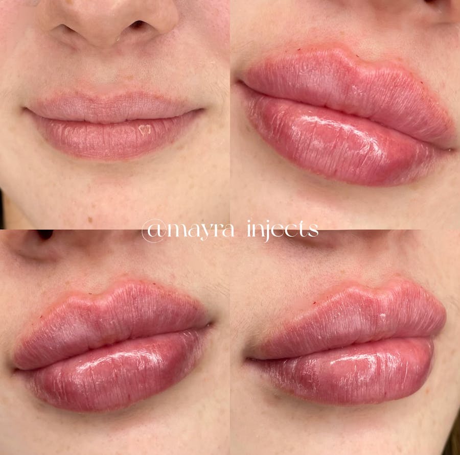 Lip Filler Before and After - Image 2