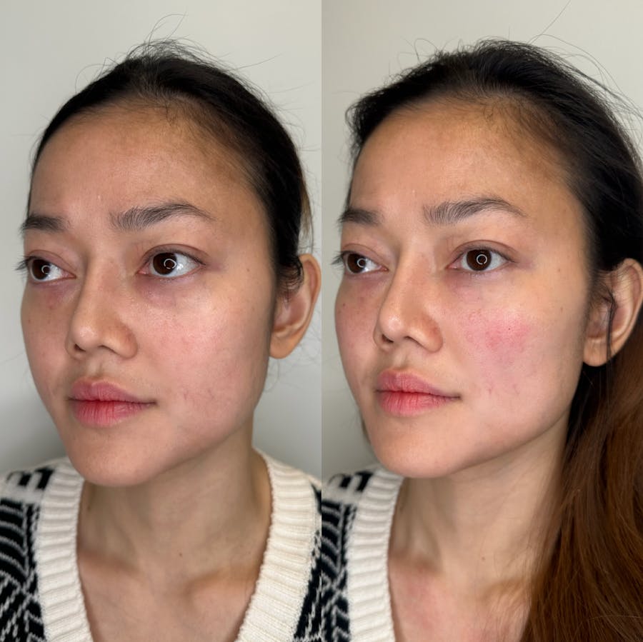 Cheek Filler Before and After - Image 2