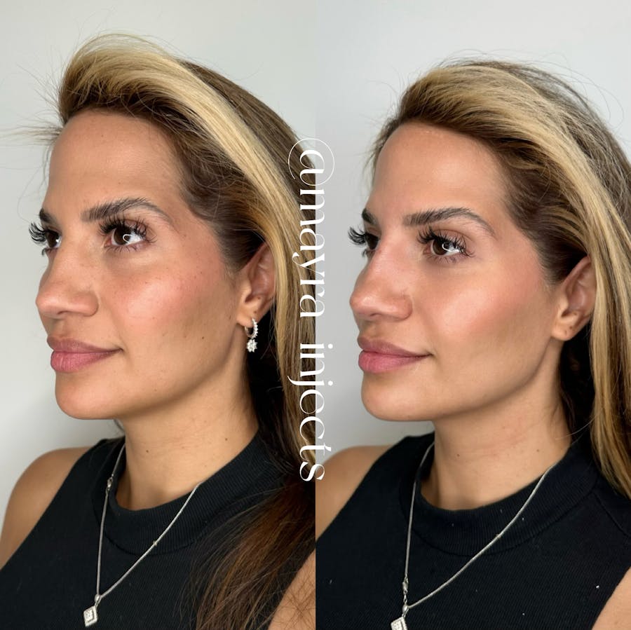 Cheek Filler Before and After - Image 3