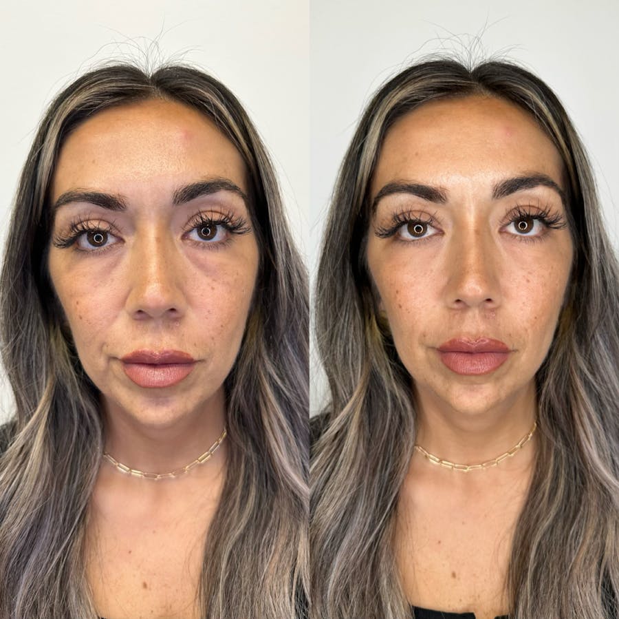 Cheek Filler Before and After - Image 1