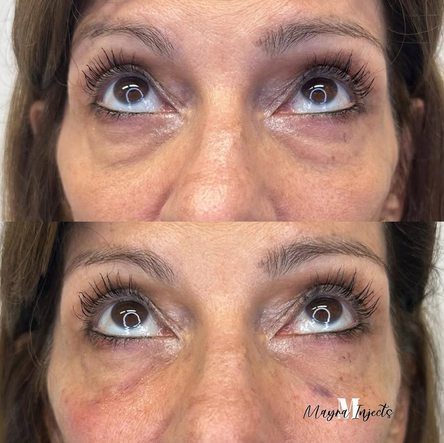 Undereye Filler Before and After - Image 1