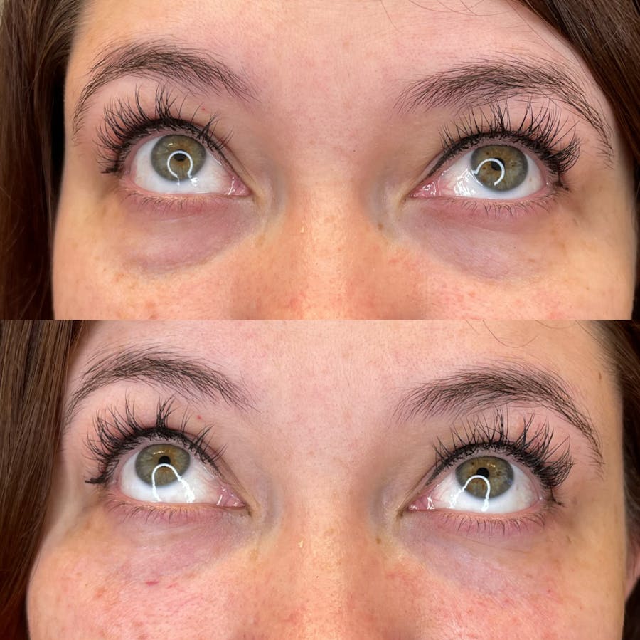 Undereye Filler Before and After - Image 2