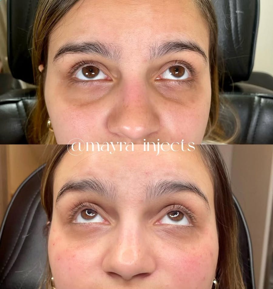 Undereye Filler Before and After - Image 3