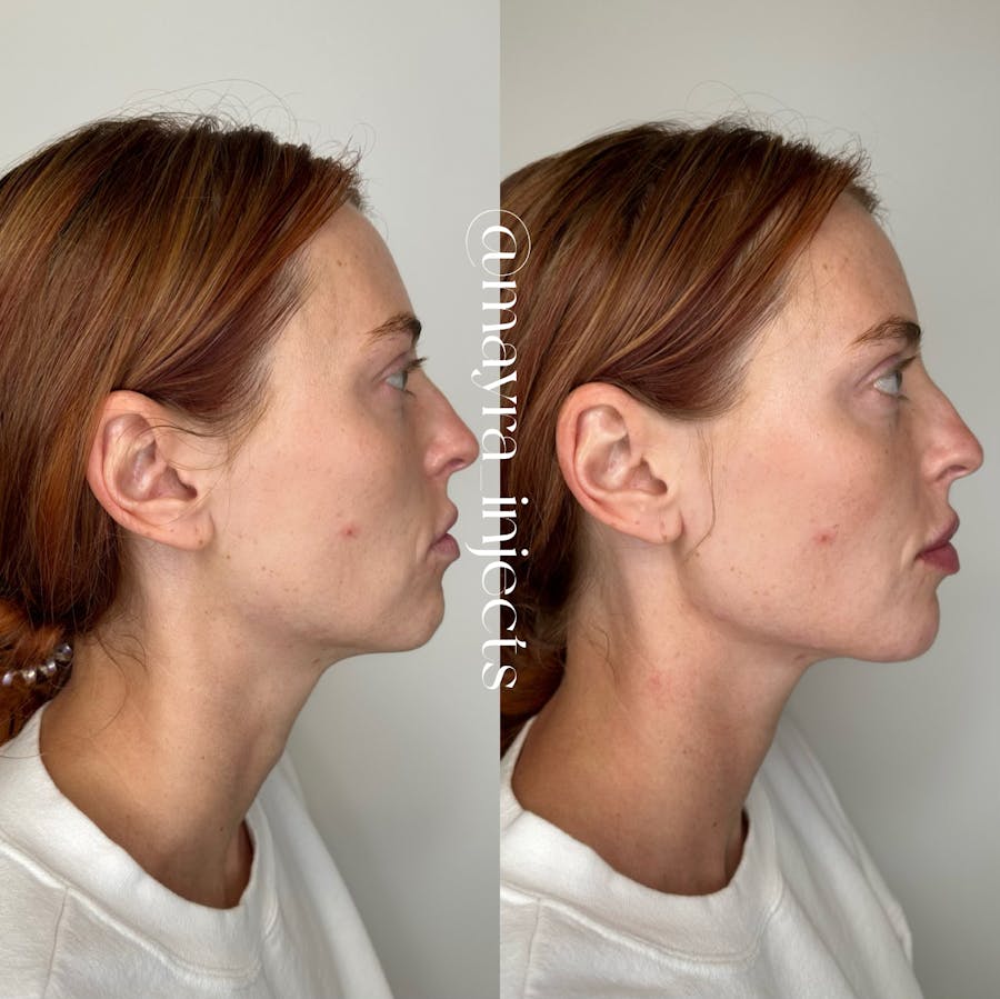 Jawline Filler Before and After - Image 1