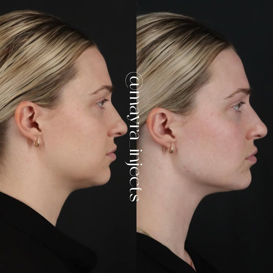 Jawline Filler Before and After - Image 2
