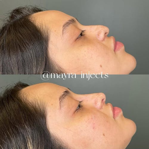 Nonsurgical Rhinoplasty Before & After - Image 1