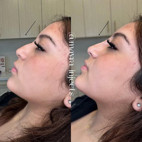 Nonsurgical Rhinoplasty Before & After - Image 2