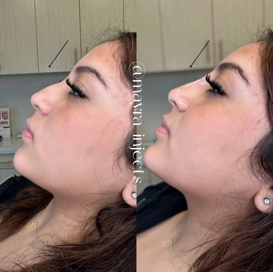 Nose Filler Before & After - Image 2