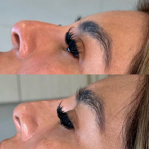 Nonsurgical Rhinoplasty Before & After - Image 3