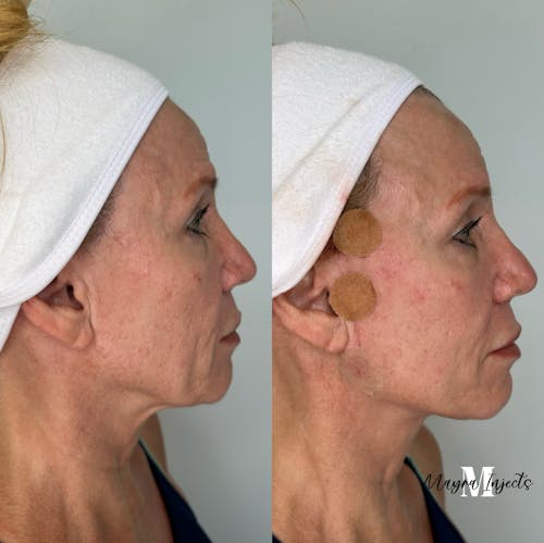 PDO Thread Lift Before & After - Image 1