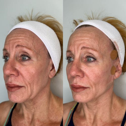 PDO Thread Lift Before & After - Image 2