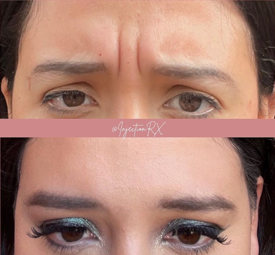 Botox/Dysport Before & After - Image 1