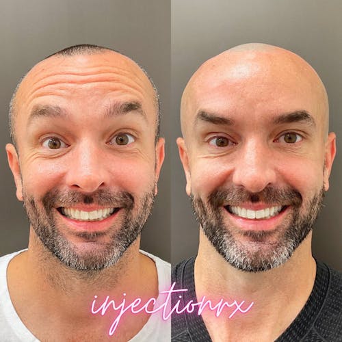 Botox/Dysport Before & After - Image 2