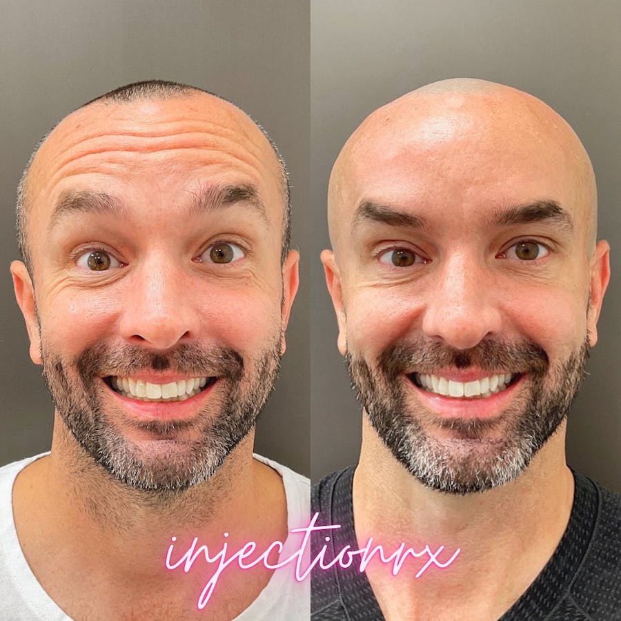 Botox/Dysport Before & After - Image 2