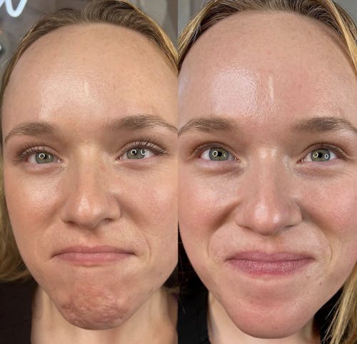 Botox/Dysport Before & After - Image 3