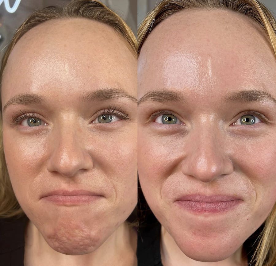 Botox/Dysport Before & After - Image 3