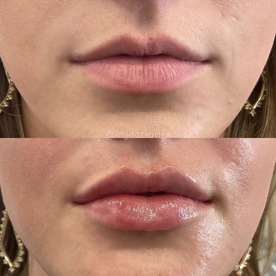 Lip Filler Before & After - Image 3