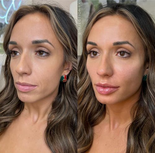 Cheek Filler Before & After - Image 1