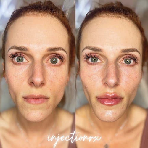 Cheek Filler Before & After - Image 2