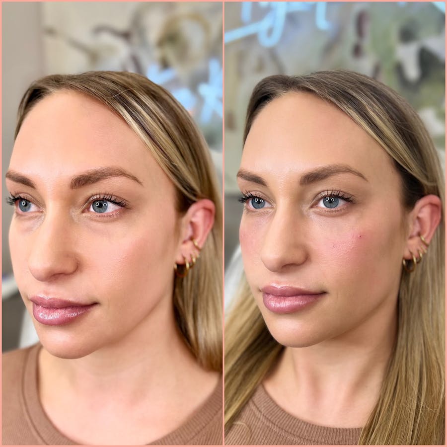 Cheek Filler Before & After - Image 3