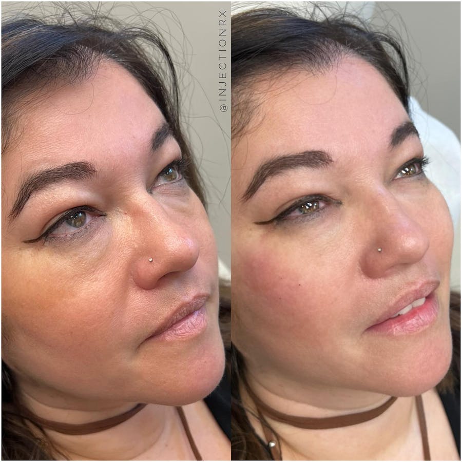 Undereye Filler Before & After - Image 1