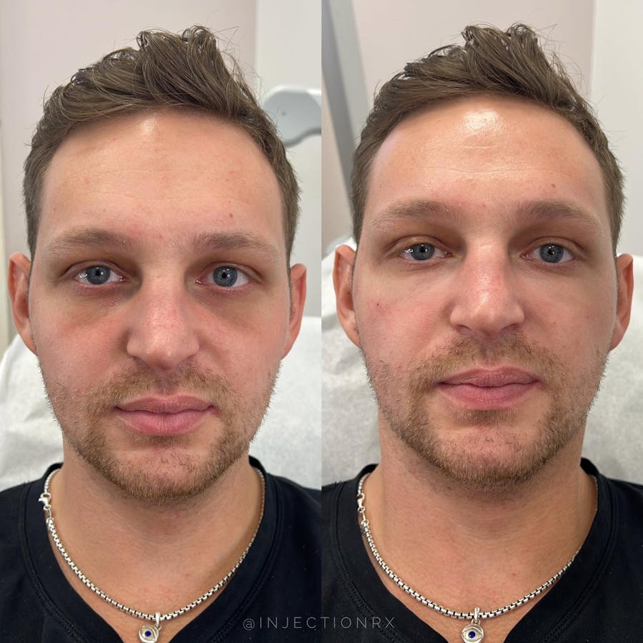 Undereye Filler Before & After - Image 2