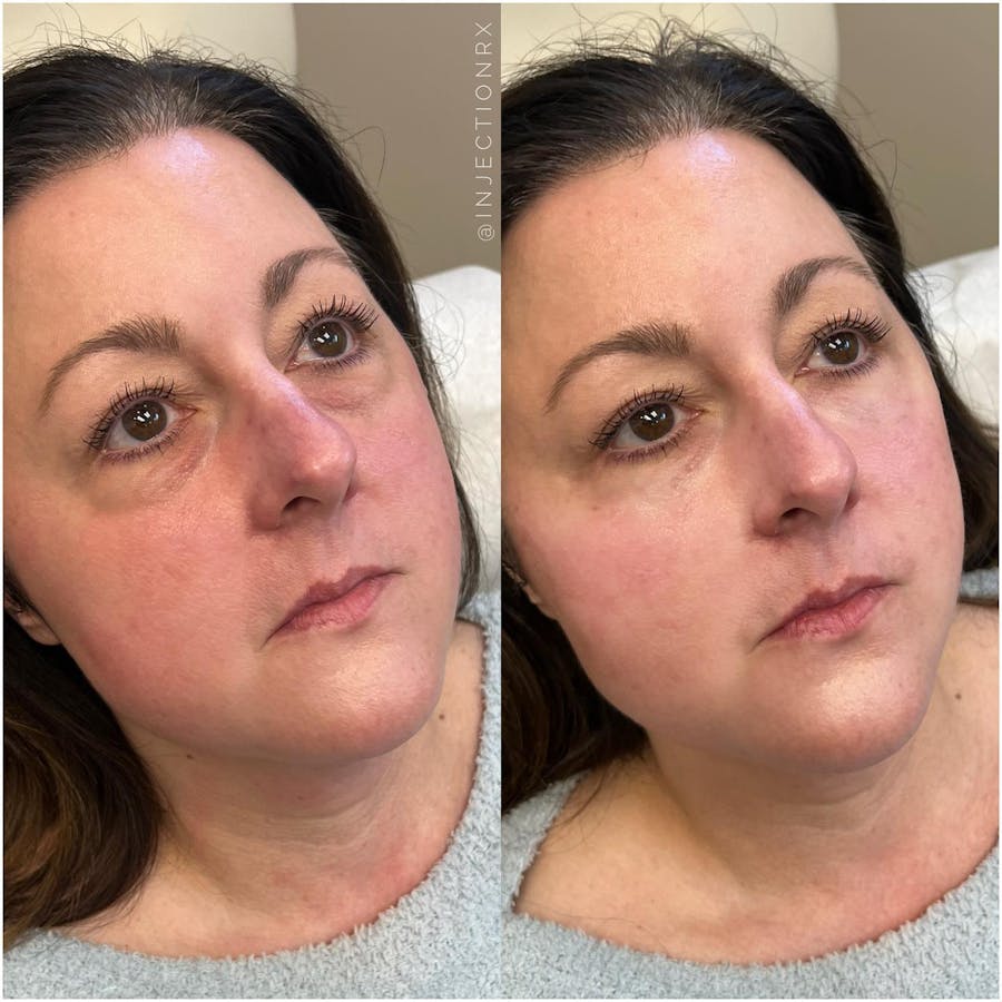 Undereye Filler Before & After - Image 3