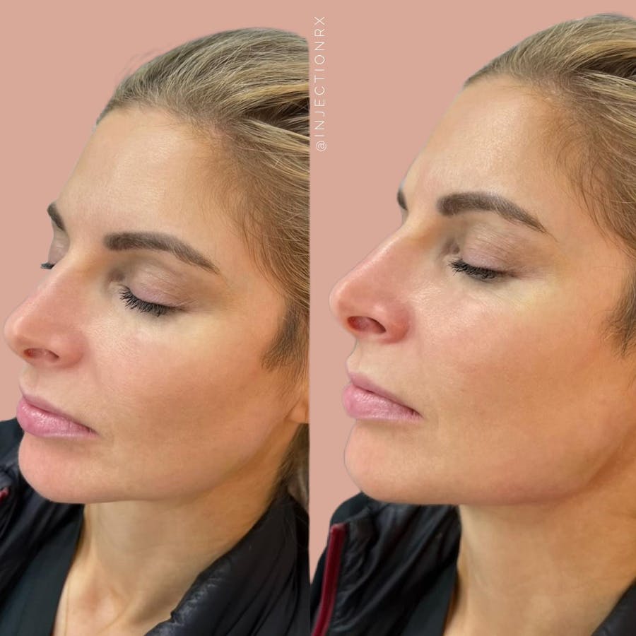 Jawline Filler Before & After - Image 2