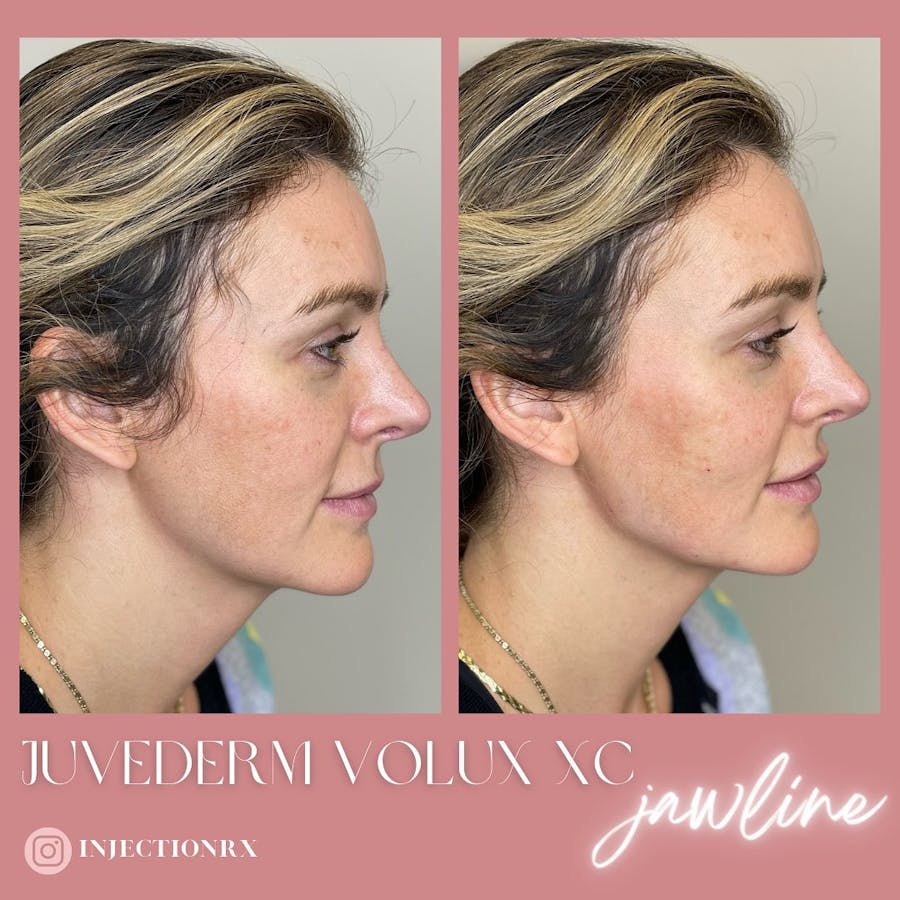 Jawline Filler Before & After - Image 3