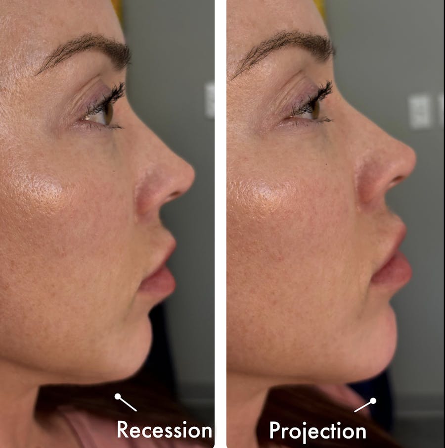 Chin Filler Before & After - Image 1