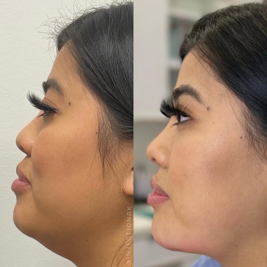 Chin Filler Before & After - Image 3