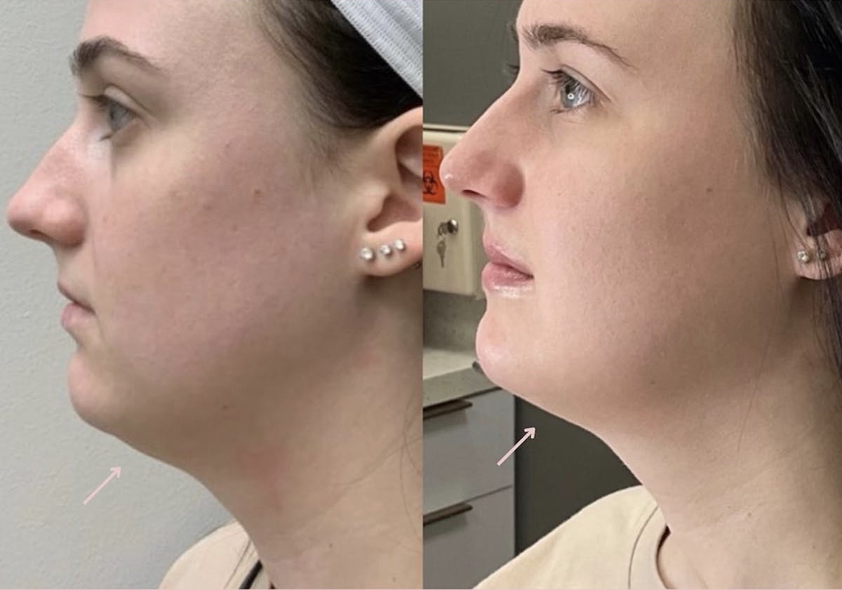 Kybella Before & After - Image 1