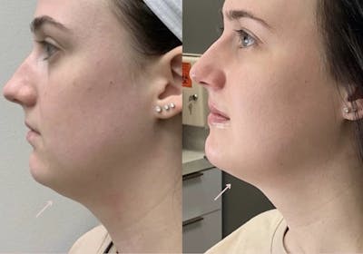 Kybella Before & After - Image 1