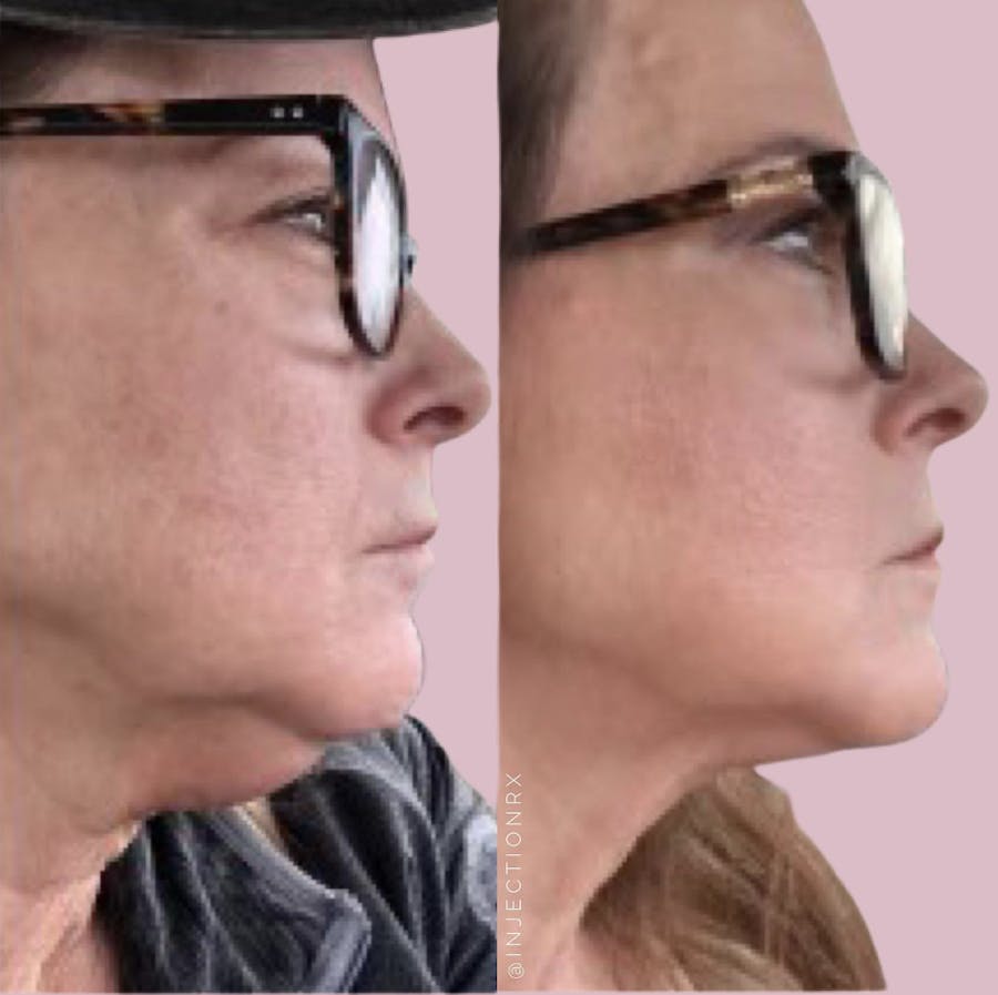 Kybella Before & After - Image 3