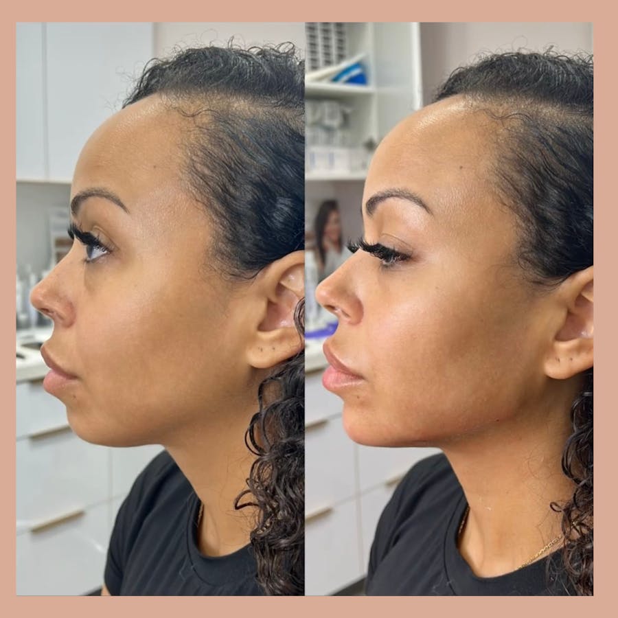 Jawline Filler Before & After - Image 1