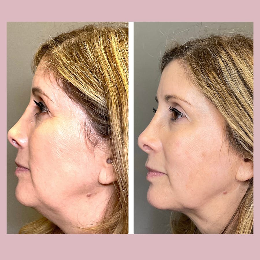 Kybella Before & After - Image 2